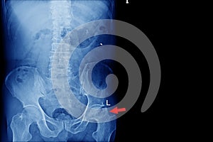 X-ray lumbo-sacral spine and pelvis No fracture, dislocation , bony destruction Normal  joint space  finding  Aseptic necrosis