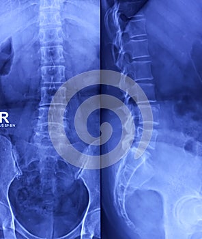 X-ray of Lumbosacral spine AP and Lateral view. Early degenerative change at lumbar spine. Limbus vertebra