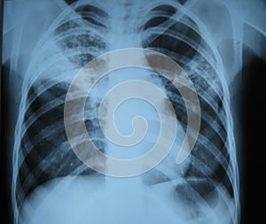 X-ray/lung photo