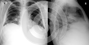 X-ray lung the front and right lateral proection. showing a large infiltrate in the middle lobe of the right lung. Pneumonia.