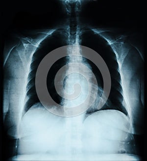 X-ray lung image.