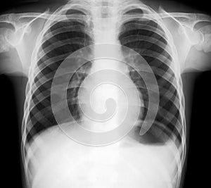 X-ray of lungs