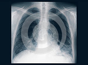 X- ray of the lungs of an adult male with bilateral pneumonia