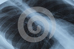 X-ray of the lungs. Close-up. Diagnostics of chronic and fatal diseases