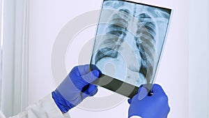 X-ray of the lungs in the doctor`s hands,to study a person`s illness,pneumonia,diagnose in the hospital,a close-up of pulmonary ed