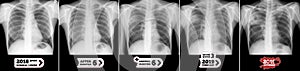 X-ray lungs: Dynamics of tuberculosis process development. Marker. Negative.