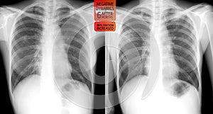 X-ray of the lungs: Escalation tuberculosis of the lungs after 6 months.