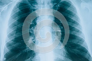 X-ray of lungs, fluorography. Medical scan of the lungs