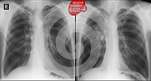 X-ray of the lungs: Operated lung. Escalation tuberculosis of the lungs after 6 months. Negative.