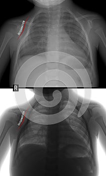 X-ray of the lungs. Thorax deformation on the right. Child. Negative, Positive.