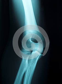 X-ray of a male arm