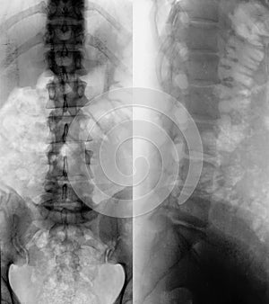 X-ray of a male spine