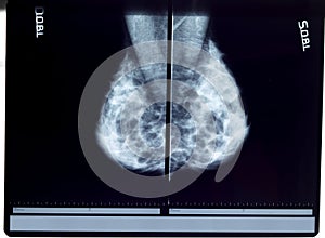 X-ray mammogram photo