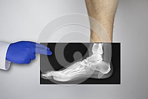 X-ray of a man`s foot. A photograph of the leg bones is applied to the patient`s feet. The radiologist examines the X-ray