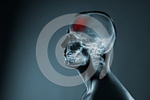 X-ray of a man's head. Medical examination of head injuries. Frontal part of the brain is highlighted by red colour.