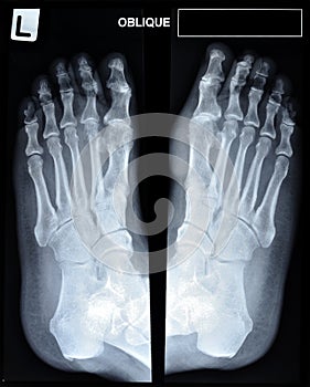 An x-ray of mature man's feet.