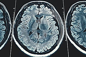 X-Ray or MRI brain scan background, magnetic resonance tomography image