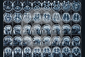 X-Ray or MRI scan or magnetic resonance tomography image of human brain and head close up, neurology concept