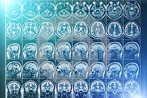 X-Ray or MRI scan or magnetic resonance tomography image of human brain and head, neurology concept