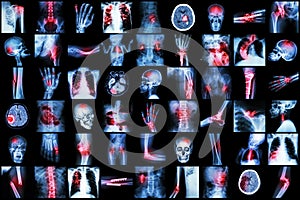 X-ray multiple disease of child and adult