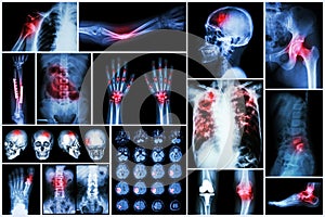 X-ray multiple disease (Stroke (cerebrovascular accident) : cva ,Pulmonary tuberculosis ,Bone fracture ,Shoulder dislocation