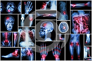 X-ray multiple disease ( stroke (CVA) , fracture , shoulder dislocation , bowel obstruction , rheumatoid arthritis , gout photo