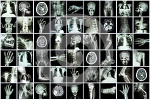 X-ray multiple part of adult and child and Disease ( Pulmonary tuberculosis Stroke kidney stone osteoarthritis bone fracture bowel