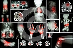 X-ray multiple part of child's body & multiple disease ( stroke , brain tumor , rheumatoid arthritis , sinusitis , gouty arthriti