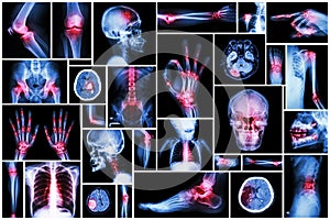 X-ray multiple part of human with multiple disease (stroke, arthritis, gout, rheumatoid, brain tumor, osteoarthritis, etc)