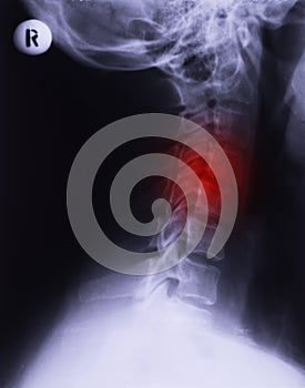 X-ray of neck