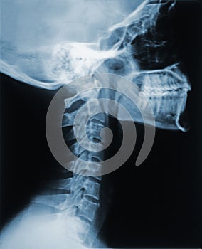 X-Ray of the Neck