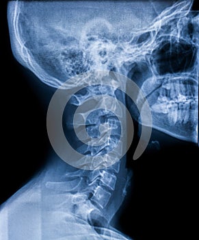X-ray of the neck