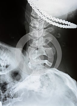 X-ray of the neck