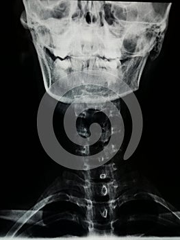 X-ray of neck and spine