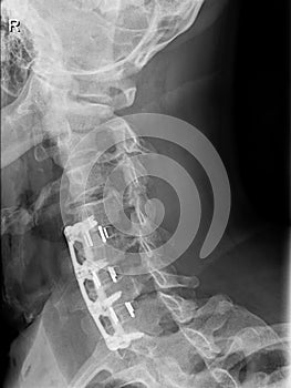 X-ray neck