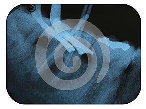 X-Ray Negative Tooth Endodontic