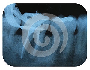 X-Ray Negative Tooth Endodontic