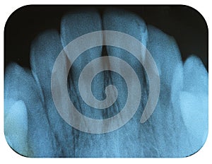 X-Ray Negative Tooth Incisors