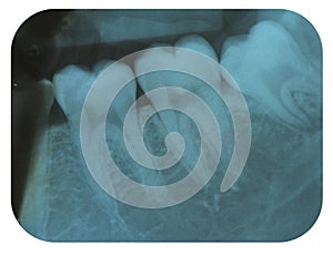 X-Ray Negative Tooth Molars