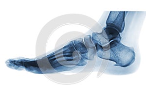 X-ray normal human foot . Lateral view .Invert color style . photo