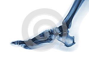 X-ray normal human foot . Lateral view . Invert color style photo