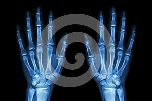 X-ray normal human hands (front) on black background