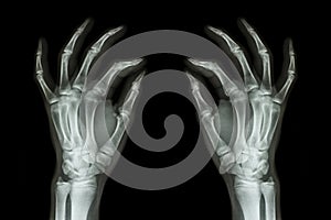 X-ray normal human hands (front) on black background