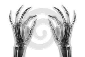 X-ray normal human hands on white background . Oblique view