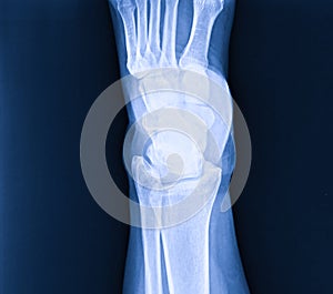 X-ray normal human\'s foot lateral photo