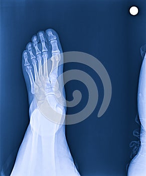 X-ray normal human\'s foot lateral photo