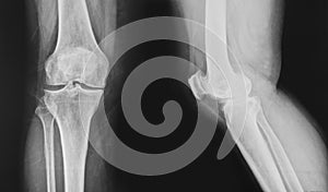 X-ray normal knee