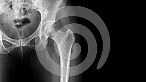 X-ray normal pelvis and hip joint . Blank area at right side