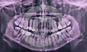 X-ray of the oral cavity with teeth. Panoramic dental X-ray. Orthopantomogram.