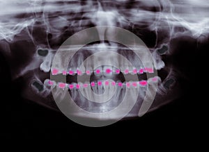X-ray of orthodontic braces photo
